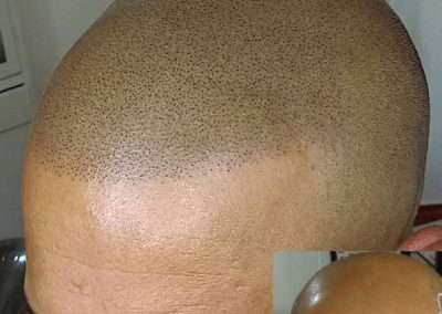 Scalp-Micro-Pigmentation-Bangkok-Thailand