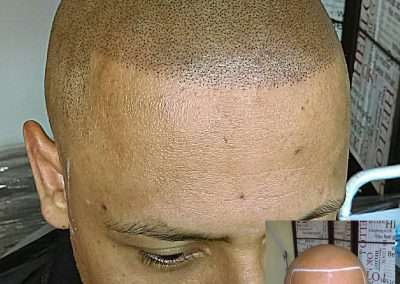 Scalp-Micro-Pigmentation-Bangkok-Thailand