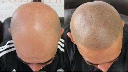 scalp-micro-pigmentation in Bangkok, Thailand