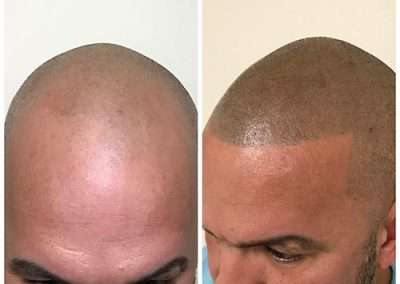 scalp-micro-pigmentation in Bangkok, Thailand