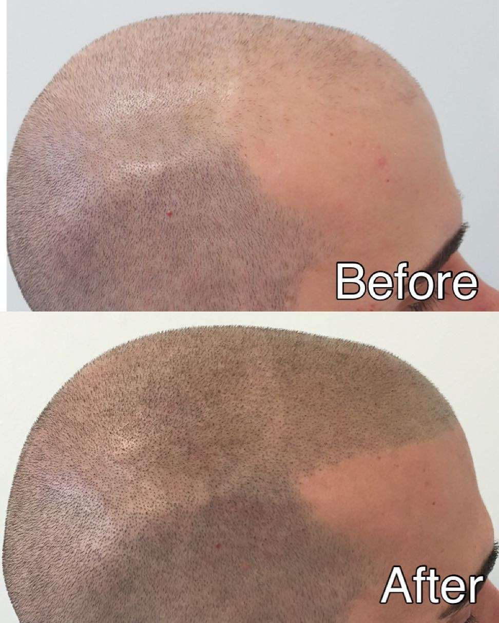 scalp-micro-pigmentation in Bangkok, Thailand