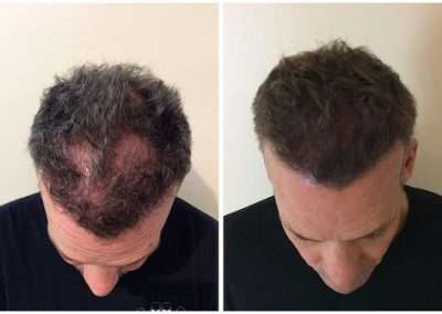 Scalp-Micro-Pigmentation-Bangkok-Thailand