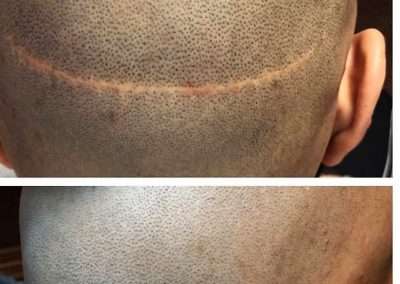 scalp-micro-pigmentation-Bangkok-Thailand